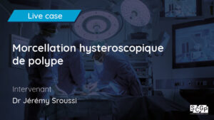 Morcellation hysteroscopique de polype