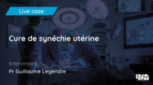 Cure de synéchie utérine
